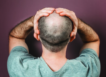 UCI Team Finds Hair in Mole May Cure Baldness